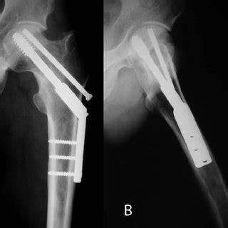 A Anteroposterior And B Lateral Radiographs Of The Left Hip Taken