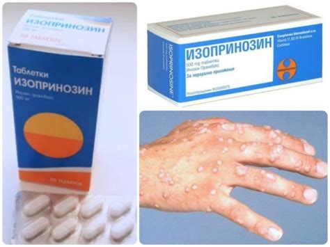 Лечение кератомы: народные рецепты, таблетки, мази - Рак Инфо