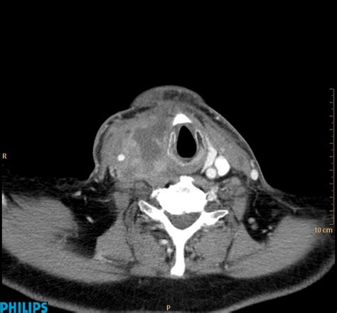 Anaplastic Thyroid Cancer Eurorad