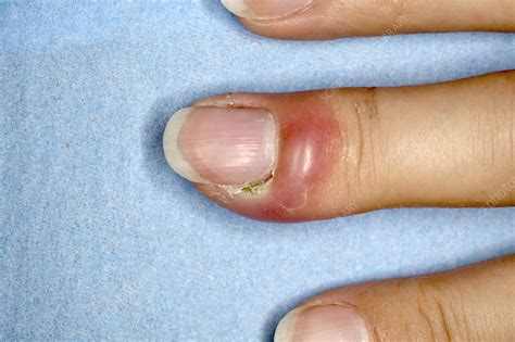 paronychia infection stock image  science photo library