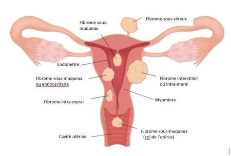 Les Fibromes De L Ut Rus