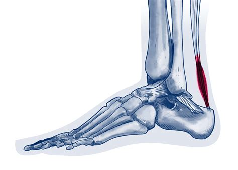 Tendinopathie du tendon d Achille ISCO Institut Spécialisé de