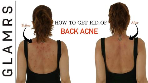 How To Get Rid Of Back Acne The Natural Way Effective Home Remedies Home Remedies For Acne