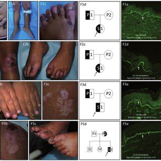 Dominant Dystrophic Epidermolysis Bullosa