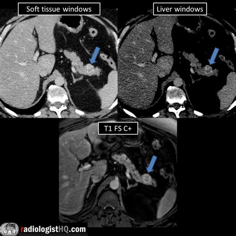 Pancreatic Tail Neuroendocrine Tumor On Ct And Mri Arrows R Radiology