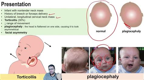 Fibromatosis Colli Pediatric Ultrasound Dr Mohamed Soliman Youtube