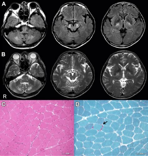 Neuroimaging And Pathological Findings A B Axial Views Of The Brain