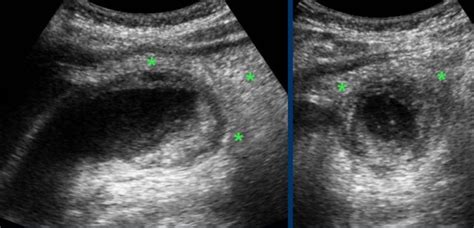 Perforated Gallbladder Ultrasound