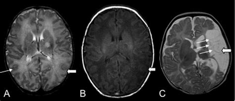 Perinatal Arterial Ischemic Stroke Presentation Risk Factors