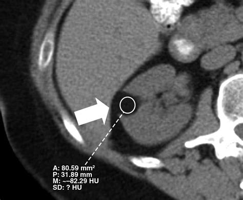 Comprehensive Imaging Manifestations Of Tuberous Sclerosis Ajr