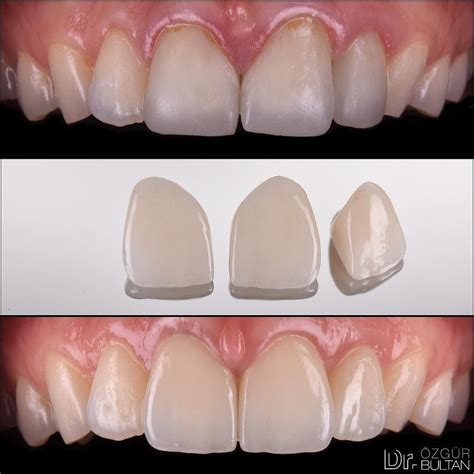 Post Op Photos Of The Case I Recently Posted Dull Zirconia Crowns