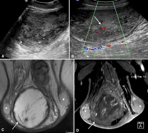 Paratesticular Cellular Angiofibroma Gray Scale A And Color Doppler