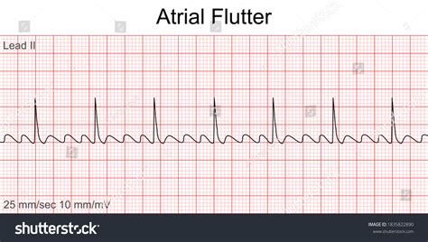 Atrial Flutter: ECG Interpretation [With Examples] Manual, 57% OFF