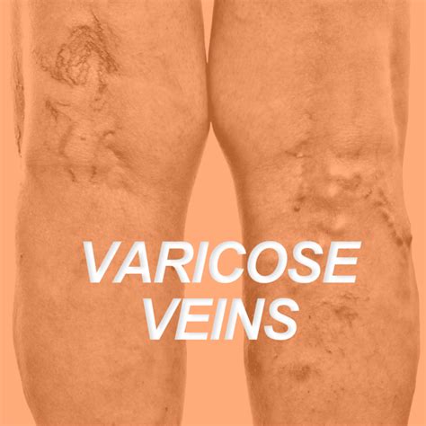 Varicose Veins Everything Trainers Need To Know