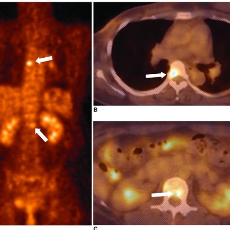 Mediastinal Lymph Node Metastasis In A 41 Year Old Woman Who Had Download Scientific Diagram