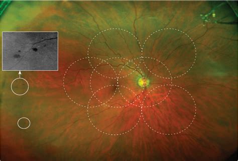 Optos Ultra Widefield Retinal Imaging System Mivision