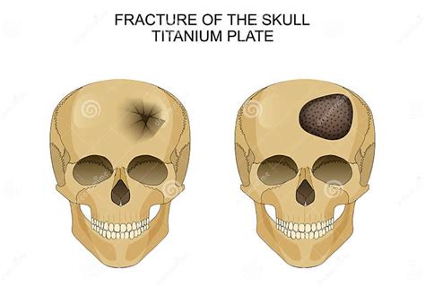 Lesión Cerebral Traumática Placa Titanium Ilustración Del Vector