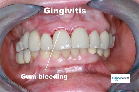 Your Ultimate Guide To Periodontal Disease Periodontitis