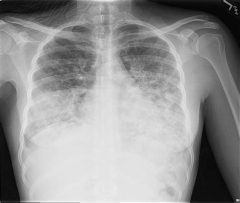 A case of a lung infiltrates — Spectral CT