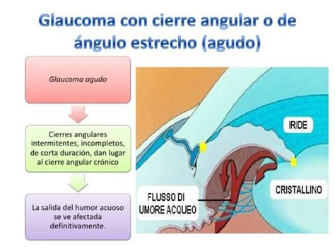 Síntomas Del Glaucoma Global Glaucoma Institute