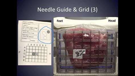 Mri Breast Biopsy Section E Tips And Tricks 3 On Targeting For Radiologists Youtube