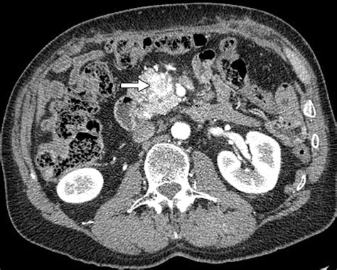 Pancreatic Carcinoma Ct