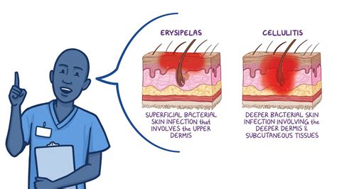 Erysipelas Cellulitis: Nursing Osmosis Video Library, 51% OFF