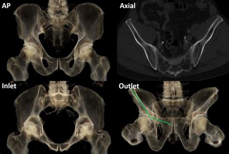 Ap Inlet Outlet X Ray And Axial Ct Cuts Of A Male Pelvis The Outlet