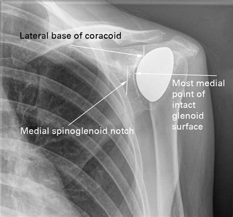 A New Classification Of Glenoid Bone Loss To Help Plan The Implantation