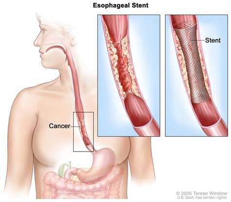 Definition of esophageal stent - NCI Dictionary of Cancer Terms - NCI