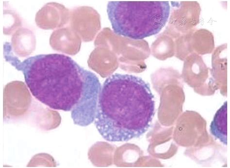 Initial Presentation Of Acute Myeloid Leukemia In A Patient With