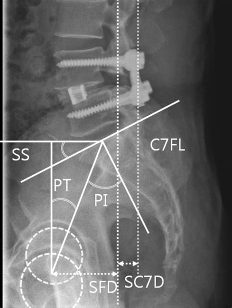 Illustration Showing The Pelvic Parameters Included In Open I