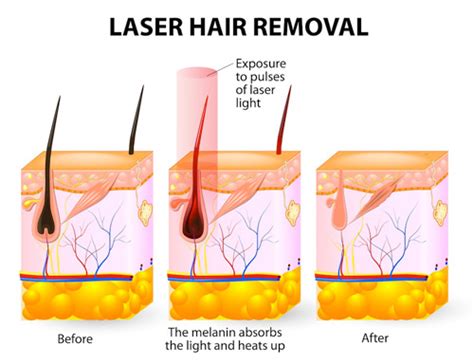 brazilian-laser-hair-removal - Laser Hair Removal NYC | New York Laser ...