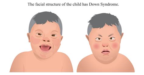 Down Syndrome: Symptoms, Causes, Prevention and Treatments