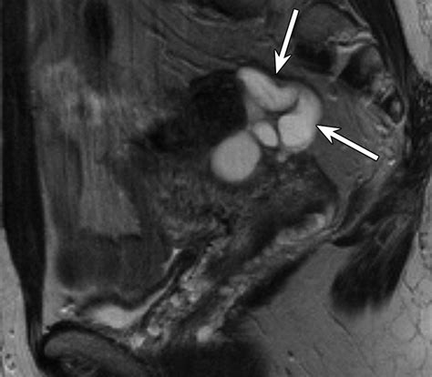 Mr Imaging Findings Of Hydrosalpinx A Comprehensive Review Radiographics