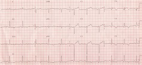 Anterior Myocardial Infarction Litfl Ecg Library Diagnosis Images