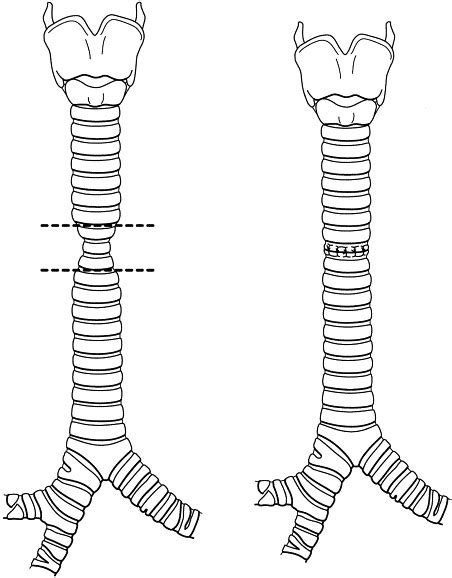 Management Of Pediatric Tracheal Stenosis And Tracheomalacia Seminars In Thoracic And