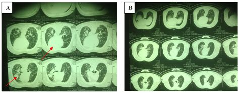 Mri Of Brain A Before B After Erlotinib Therapy A March 2012 B