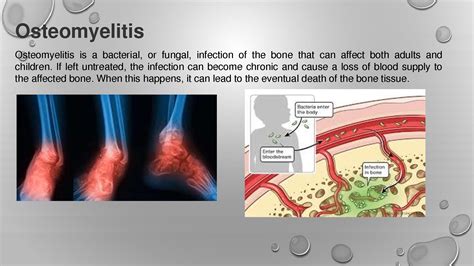 Solution Osteomyelitis Studypool