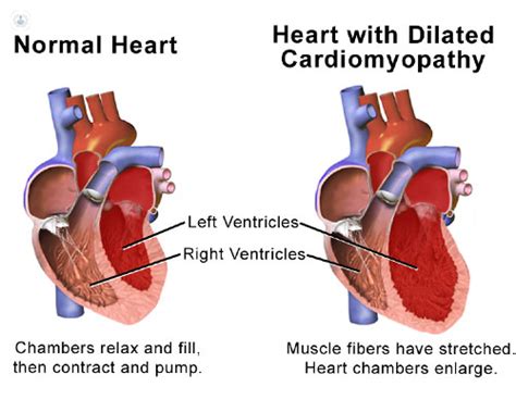 miocardiopatia dilatada  es sintomas  tratamiento top doctors