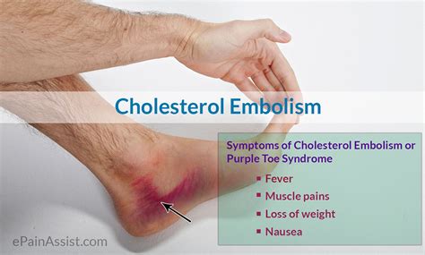 Cholesterol Embolism Or Purple Toe Syndrome Causes Symptoms Diagnosis