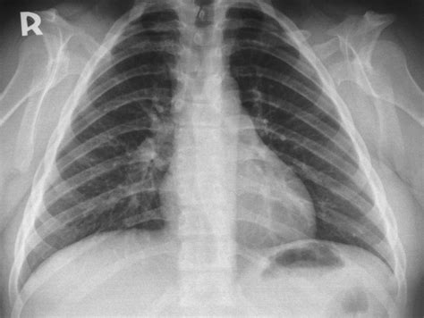 Cleidocranial Dysostosis Bone And Spine