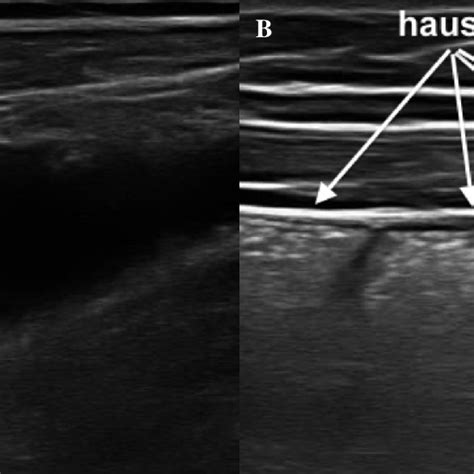 Echostructure Of A Small Intestine Loop Valvulae Conniventes A And Download Scientific