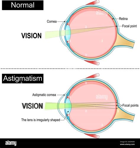 Myopia astigmatism Stock Vector Images - Alamy