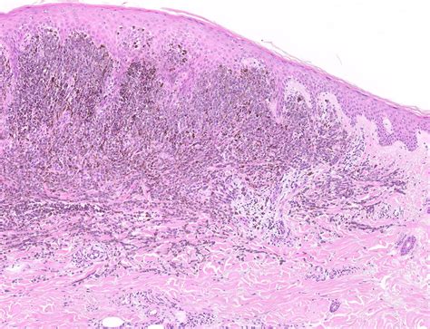 Melanoma Histology