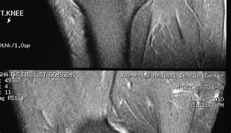 Posterior Horn Meniscal Tear Radiopaedia