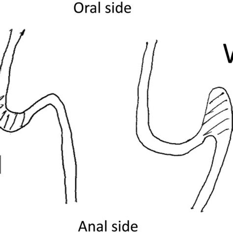 The Illustrated Classification Of Types Of Intussusception Type M