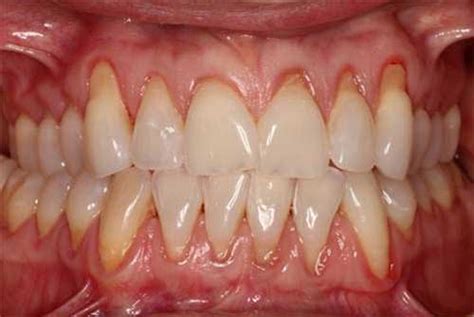 Receding Gums Stages