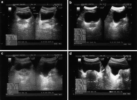 Enlarged Prostate Ultrasound