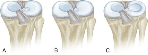 Discoid Lateral Meniscus Musculoskeletal Key